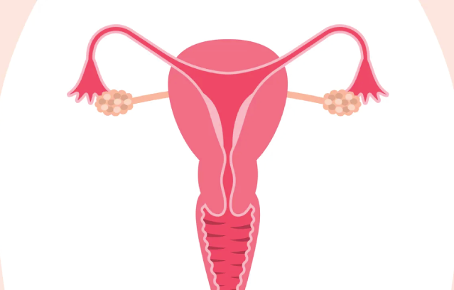 Ovarian Cancer